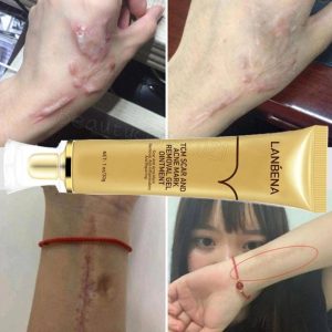 ژل کرم اسکار و جای جوش لانبنا